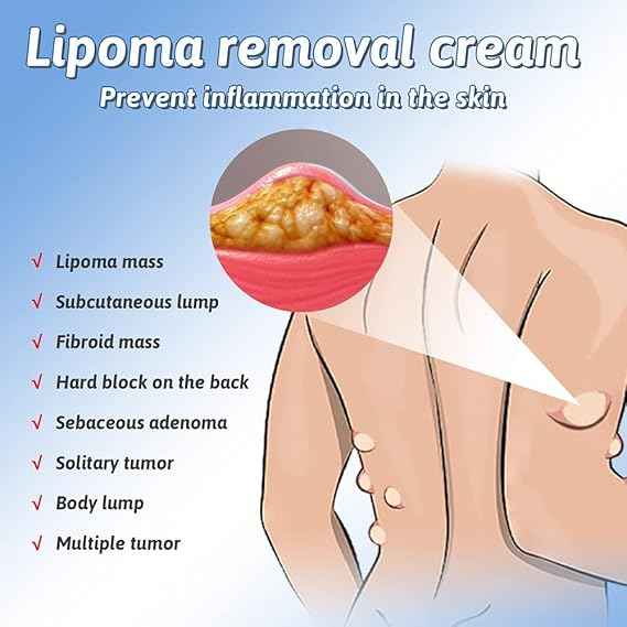 Lipoma Removal And Body Smoothing Cream (50 Grams)