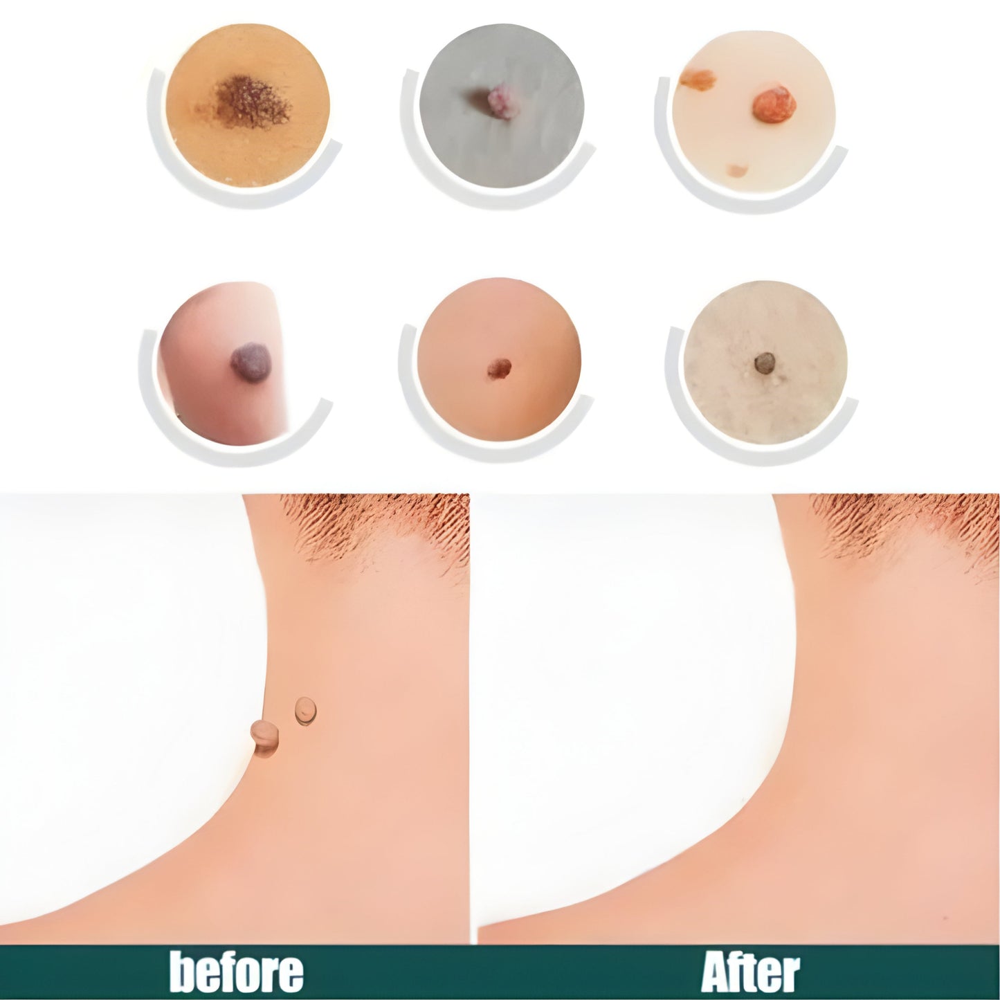 DermaSmooth Skin Tag, Moles & Warts Remover (72 Patches)